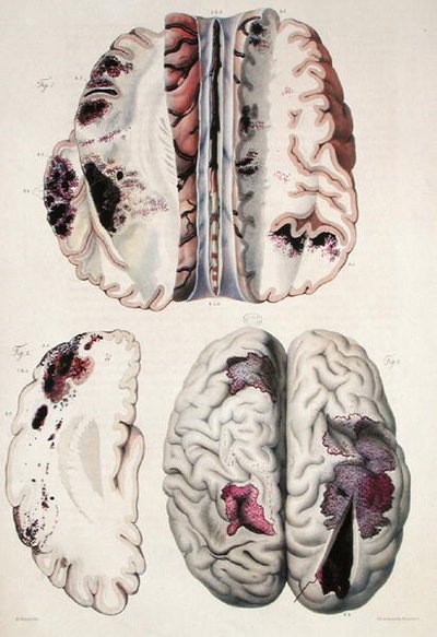 毛细血管麻痹症，出自让-克鲁维耶（1791-1874）1828-42年的《人体解剖学》（彩色雕刻）。 作者 安托万·查扎尔（Antoine Chazal）