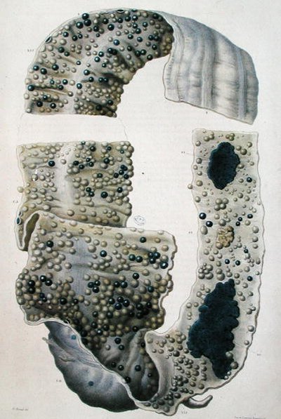肠道疾病，摘自让-克鲁维耶（Jean Cruveilhier）（1791-1874）1828-42的《人体解剖学》（彩色雕刻）。 作者 安托万·查扎尔（Antoine Chazal）