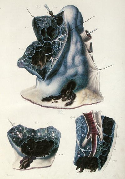肺部疾病，摘自让-克鲁维耶（1791-1874）的《人体解剖学》，1828-42（彩色雕刻）。 作者 安托万·查扎尔（Antoine Chazal）