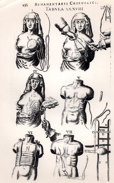手术于乳腺癌，来自Armamentarii Chirurgici，Johannes Schultes（1595-1645）于1672年在阿姆斯特丹出版 作者 荷兰学校