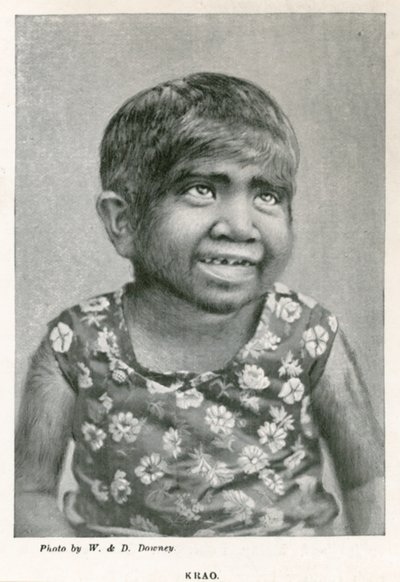Krao，The Missing Link，于1887年在伦敦威斯敏斯特水族馆展出 作者 英国摄影师