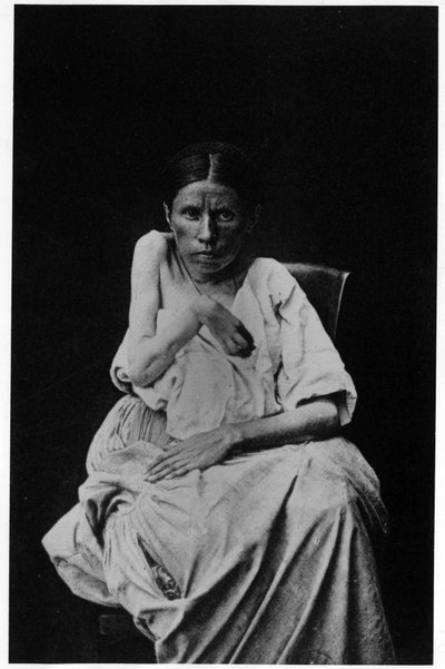 Photograph of a patient suffering from hemiplegic epilepsy, -in “” photographic iconography of the Salpetrière, Bourneville and P. Regnard, Paris 作者 法国摄影师