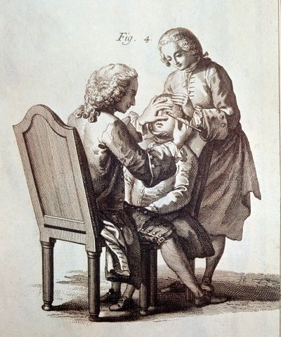 医生为白内障患者做手术，插图选自 Denis Diderot 和 Jean le Rond d