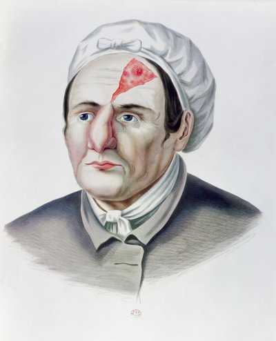 皮肤移植手术后，来自巴黎的Alexander Auvert的Selecta Praxis Medico-Chirurgica，1856年 作者 法语学校