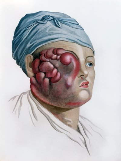 来自男性皮肤疾病描述的癌症由男爵Jean Louis Alibert（1768-1837）巴黎，1806年 作者 法语学校