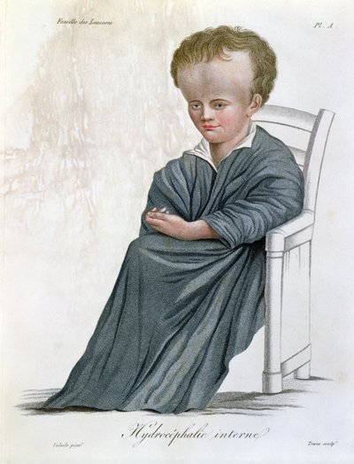 内部脑积水，来自Nosologie Naturelle by Baron Jean Louis Alibert（1768-1837），由Tresca雕刻，1817年 作者 法语学校