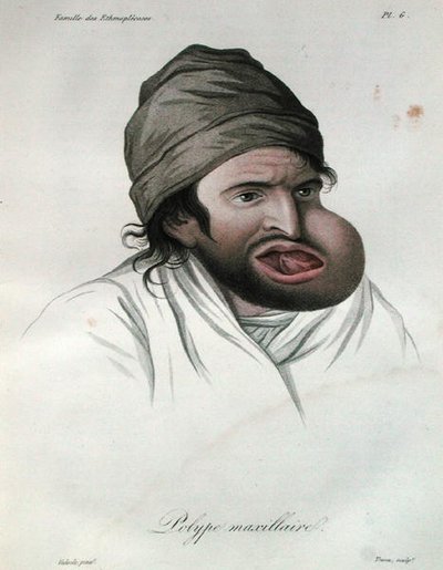 上颌骨息肉，摘自让-路易斯-阿里伯特男爵（1768-1837）的书 1817年（彩色雕刻）。 作者 法语学校