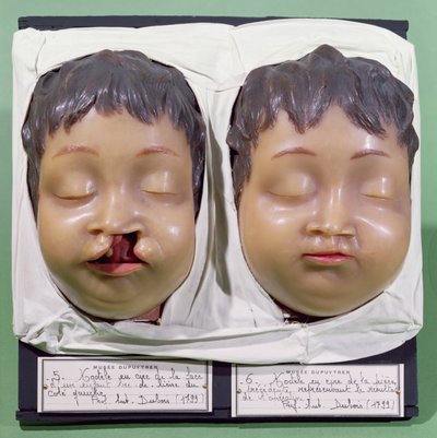 模特展示了一个孩子的脸，在1799年由Antoine Dubois（1756-1837）执行的操作之前和之后纠正了一个harelip（蜡） 作者 法语学校