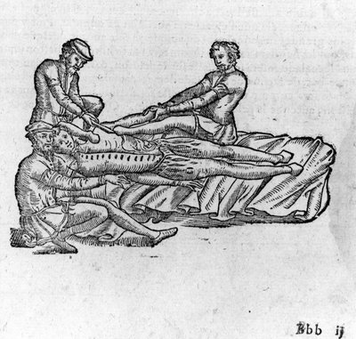 缩减脱臼，载于《安布罗伊斯-帕尔医学论文集》，约1560年。 作者 法语学校