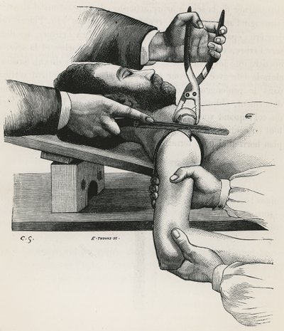 肩部切除术，来自 Louis-Hubert Farabeuf 的“Précis de Manuel Opératoire” 作者 法语学校