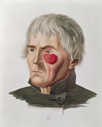 手术前的皮肤病，来自巴黎的Alexander Auvert的Selecta Praxis Medico-Chirurgica，1856年 作者 法语学校
