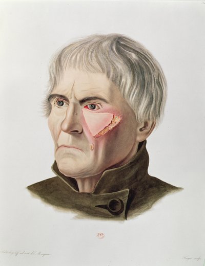 皮肤移植手术，来自巴黎的Alexander Auvert的Selecta Praxis Medico-Chirurgica，1856年 作者 法语学校