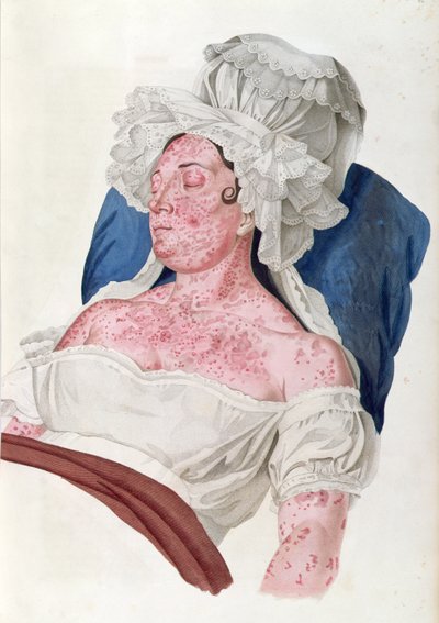猩红热的女人，来自男爵Jean Jean Alibert（1768-1837）的书，由Choupard，1833年刻。 作者 法语学校