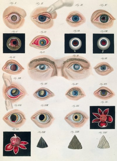 先天性眼睛异常的描述，来自疾病的临床表现和Mesnschlichen眼的致盲错误，作者：Friedrich August von Ammon（1799-1861）1838 作者 德国学校