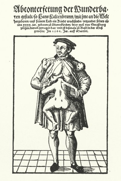 Hans Kaltenbrunn 和他未开发的连体双胞胎（雕刻） 作者 德国学校