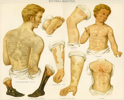 皮肤病，第1890页 作者 德国学校