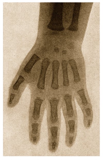 X射线的孩子手c.1890 作者 德国学校