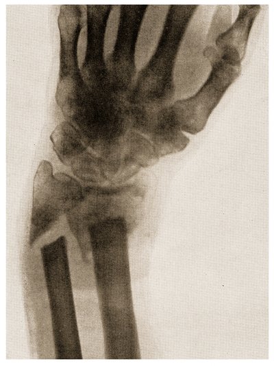 手腕骨折的X射线c.1890 作者 德国学校