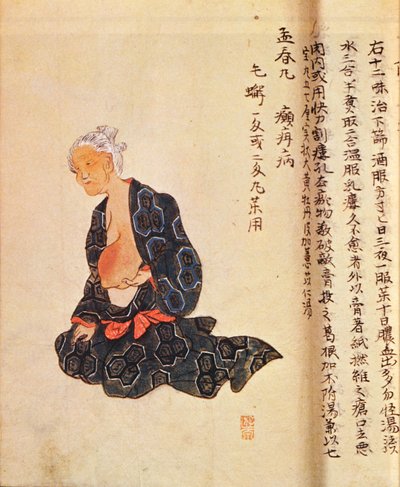 第一次手术治疗乳腺癌是由Seishu Hanaoka（1760-1836）在1804年在全身麻醉下进行的 作者 日本学校