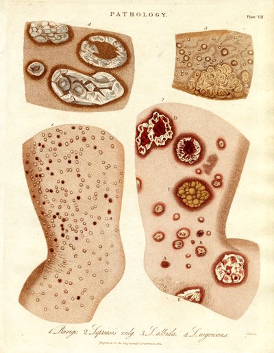 病理性皮肤病：Schurigie；Leprous Skin；Pallada 和 Impetigo 作者 约翰·帕斯