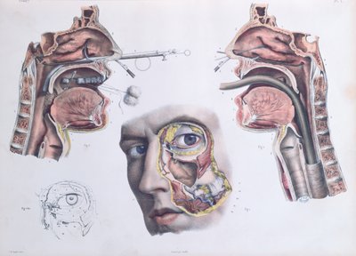 一项鼻腔手术，由Jean-Baptiste Marc Bourgery撰写的“人类解剖学完整论文”（1797-1849）1866-67 作者 尼古拉斯·亨利·雅各布