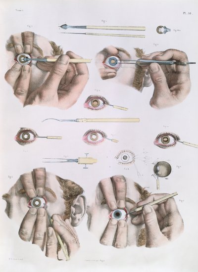 从Jean-Baptiste Marc Bourgery（1797-1849）1866-67开始的“人类解剖学完整论述”中的手术 作者 尼古拉斯·亨利·雅各布