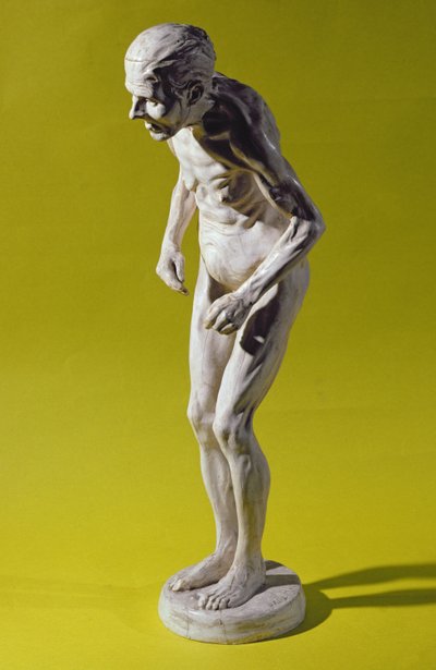 帕金森病（石膏）女人的身影 作者 保罗·玛丽·路易斯·皮埃尔·里希