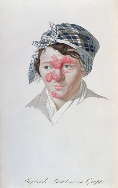 Syphilic cluster pustules，来自Baron Jean Louis Alibert（1768-1837）1838年的一本书 作者 萨尔瓦多·特雷斯卡