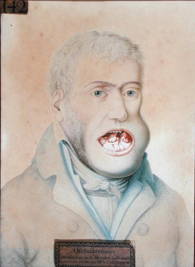 纪尧姆-杜普耶伦（1777-1835）成功地进行了下颌骨肉瘤手术（纸上铅笔）。 作者 法语学校