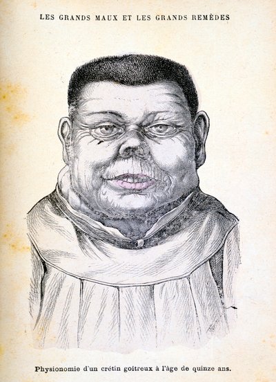克雷丁（Cretin）15岁，c1890年 作者 不明