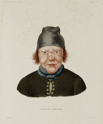 Diseases, Leprosy Female leper, Iceland, early 19th century 作者 不明