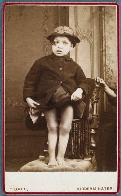 Diseases, Rickets (Rachitisme, jambes rachitiques) Child with rickets 作者 不明