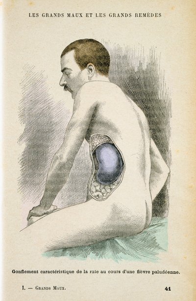 疟疾患者的典型脾脏增大，c1890 作者 不明