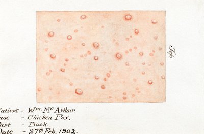 疾病，水痘 皮肤病水痘的水彩画，1902 年 2 月 27 日 作者 不明