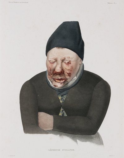 Diseases, Leprosy 作者 不明