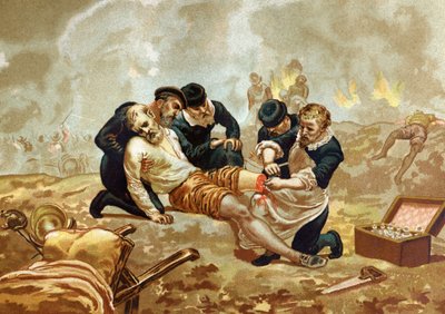 Ambroise Pare Medicin和法国外科医生（约1509-1590）在截肢后练习结扎。巴塞罗那1877年。 作者 未知艺术家