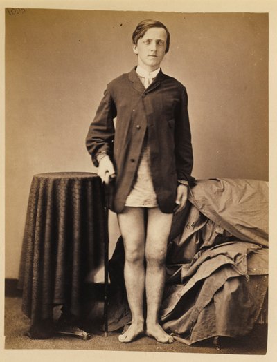 二等兵 G.W. Warrington，右髌骨枪弹骨折后恢复，未截肢，摘自外科图片目录 作者 威廉·贝尔