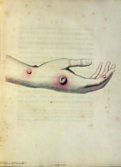 Sarah Nelmes手臂上的牛痘脓包，由Edward Jenner（1749-1823）撰写的“对Variolae Vaccinae的原因和影响的调查”，由Pearce雕刻，c.1800 作者 威廉·斯克尔顿