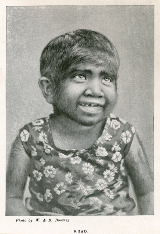 Krao，The Missing Link，于1887年在伦敦威斯敏斯特水族馆展出 作者 英国摄影师