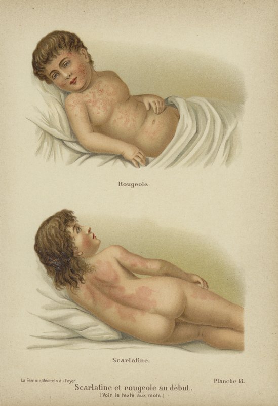 Early symptoms of measles and scarlet fever (colour litho) 作者 德国学校
