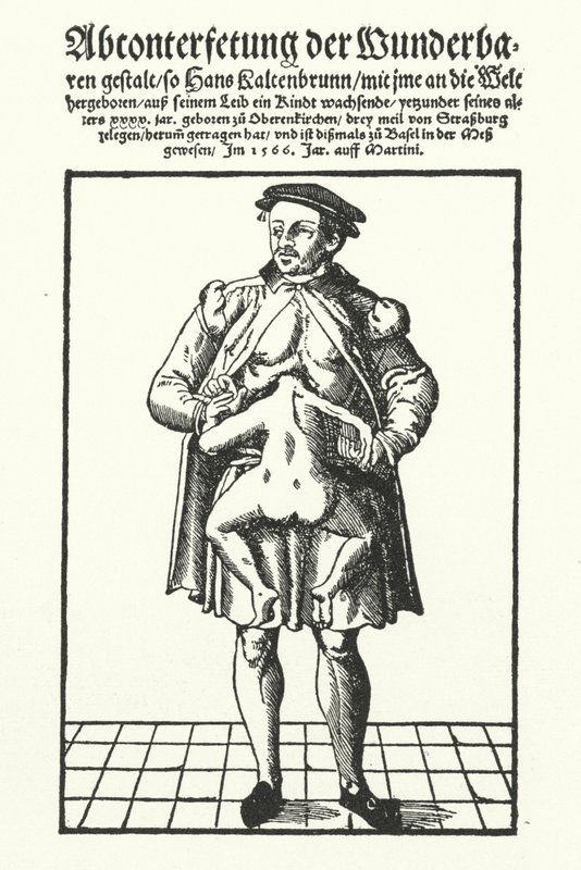 Hans Kaltenbrunn 和他未开发的连体双胞胎（雕刻） 作者 德国学校